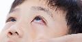 Penyebab Mata Merah Pada Anak Serta Cara Mencegah Kerusakan Mata Anak